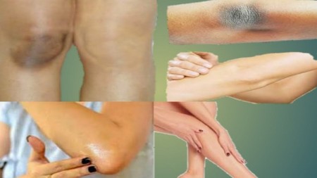 হাঁটু ও কনুইয়ের কালচে দাগ দূর করার উপায়
