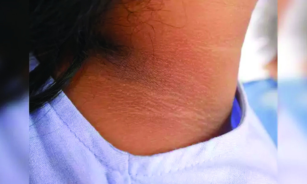 ঘাড়ের কালো দাগ দূর করবেন যেভাবে